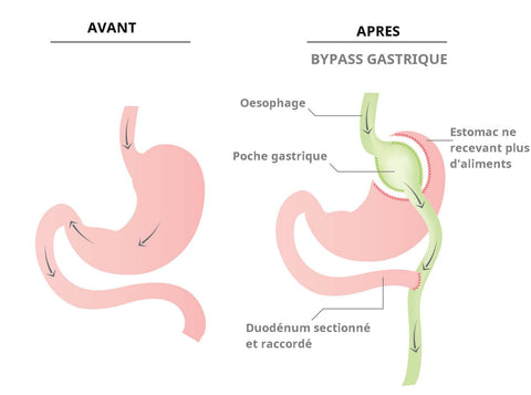 C'est quoi un bypass gastrique